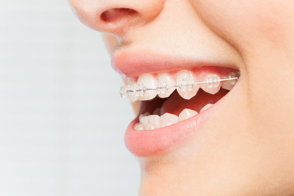 This Is How to Clean Your Teeth With Braces