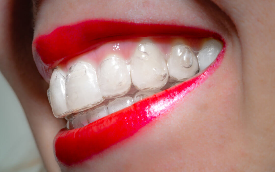 7 Signs You Are a Good Candidate for Invisalign