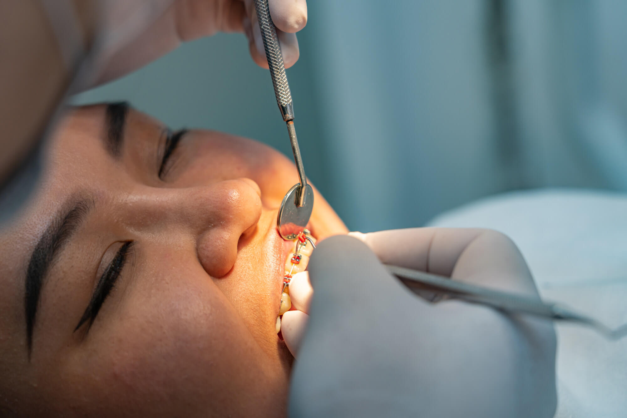 Top 5 Reasons You Should Visit an Orthodontist