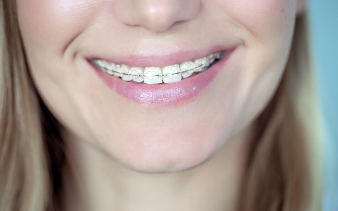 Ceramic Braces before and after in Conway, AZ: Transform Your Smile