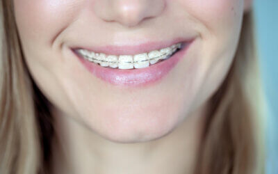 Ceramic Braces before and after in Conway, AZ: Transform Your Smile