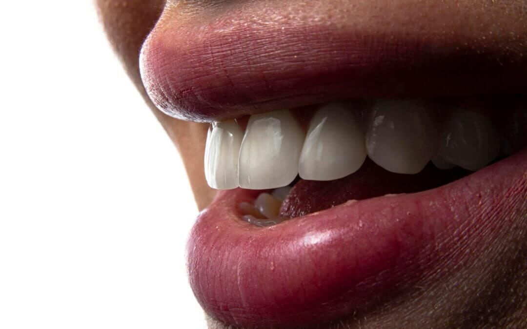 Unlock Your Best Smile: 6 Invisalign Rules You Must Follow