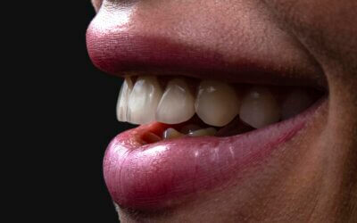 Braces for Overbite: Transform Your Smile Today