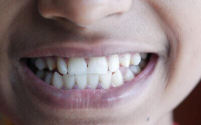 Why You Can Often Correct an Underbite Without Jaw Surgery